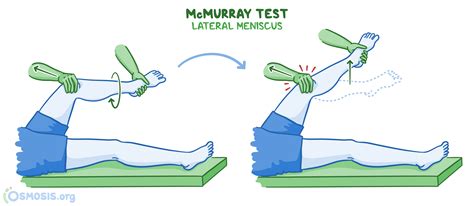 positive mcmurrays test